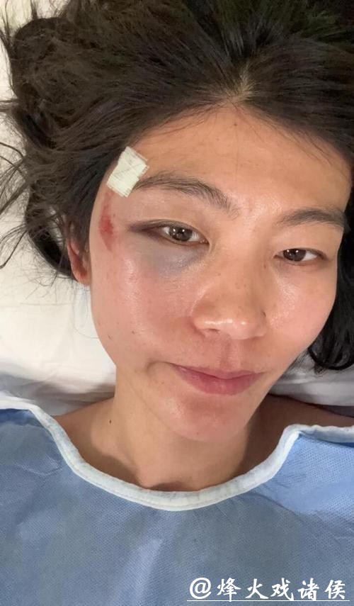 头部冲下摔倒缝一针，刘佳宇报平安，发生了什么？